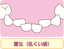 治療について 小児歯科