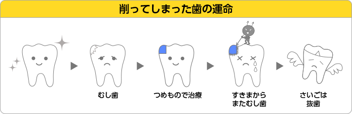 削ってしまった歯の運命