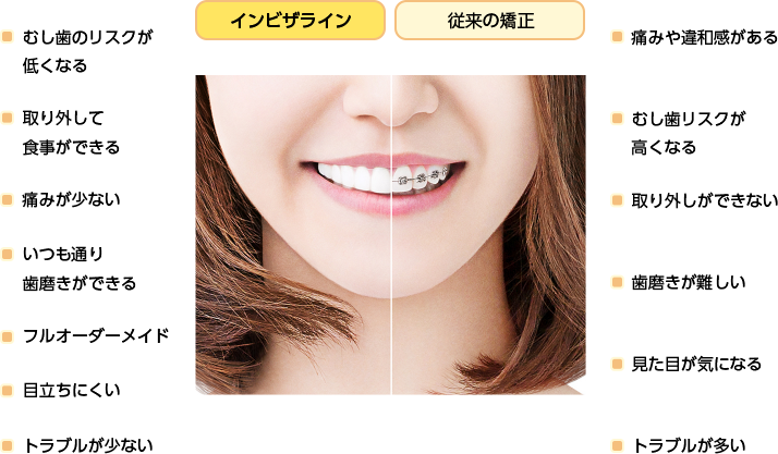 インビザライン